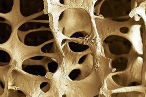 What Is The Best Way To Prevent Osteoporosis